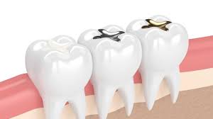 tooth colored fillings