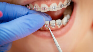 Braces for Kids - Costs and Does Your Child Need Them?
