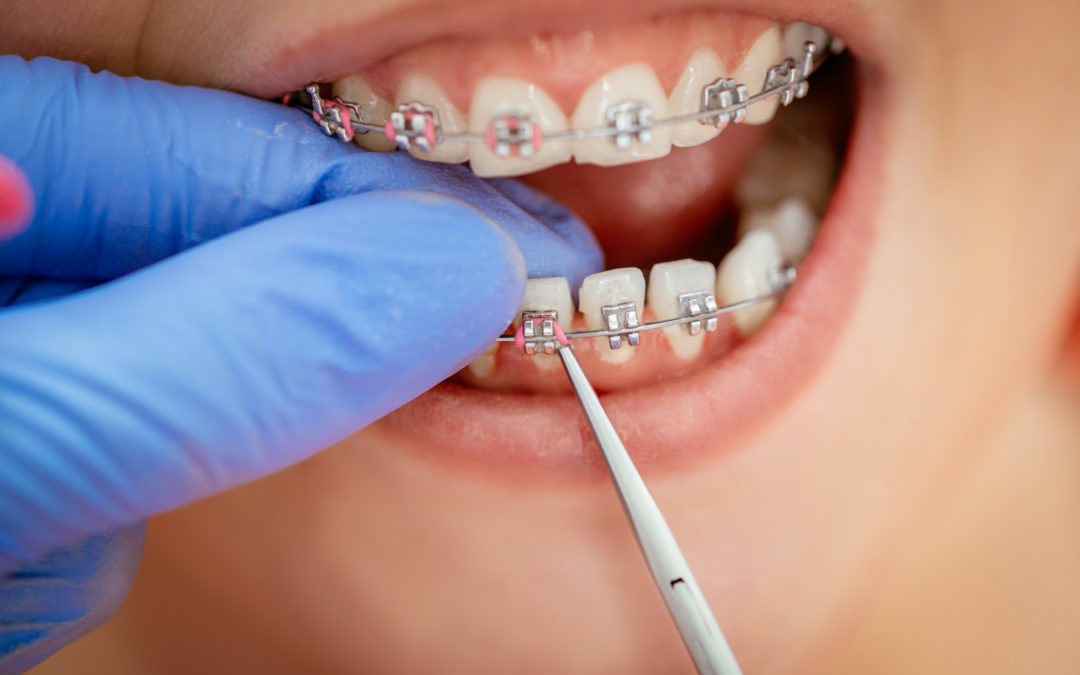 Braces for Kids - Costs and Does Your Child Need Them?